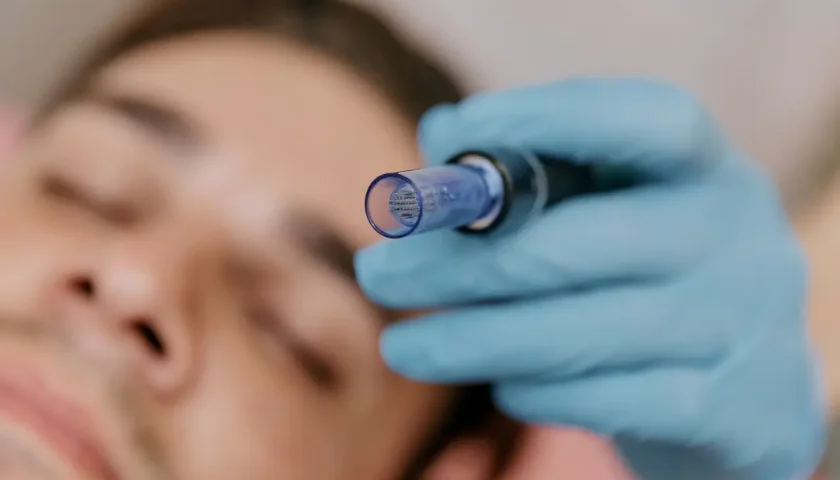 Mezoterapia mikroigłowa skóry głowy w gabinecie trychologicznym TRYCHOMED mgr Rozalia Bugara